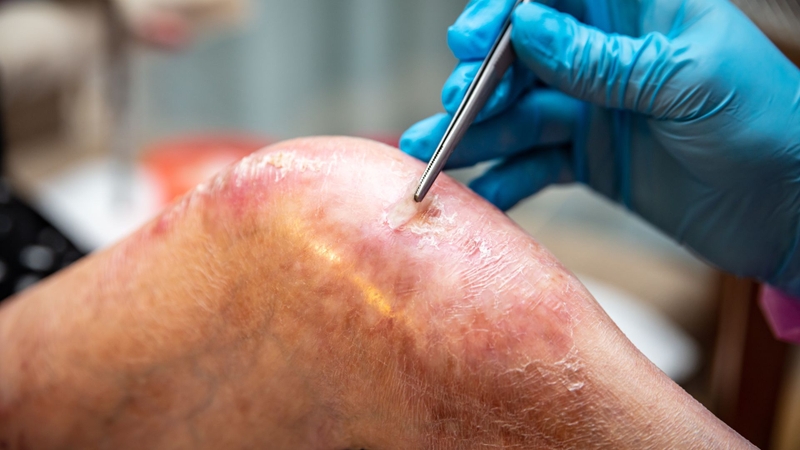 Không tự ý bóc vảy, nên để vảy bong tự nhiên để hạn chế tổn thương và giúp da hồi phục tốt hơn