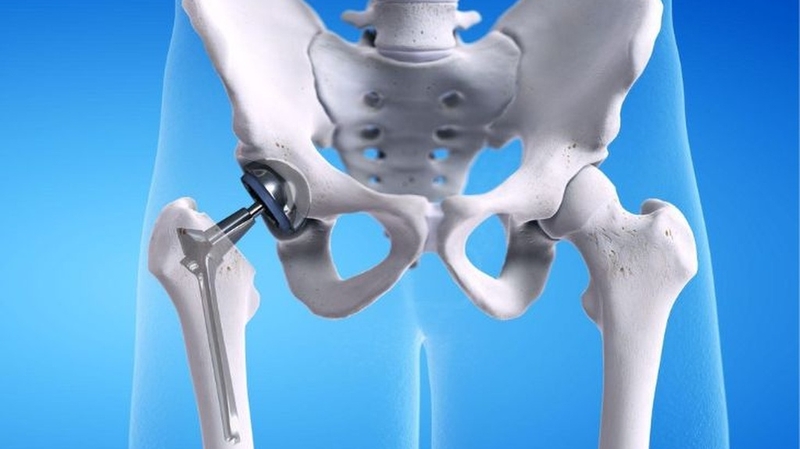 Biến chứng sau thay khớp háng và những điều cần lưu ý 4