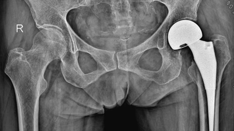 Biến chứng sau thay khớp háng và những điều cần lưu ý 3