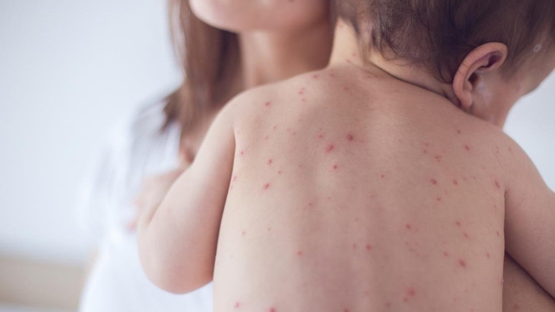 bien-chung-sau-tiem-chung-nhung-dieu-can-biet 4