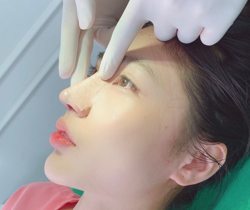 Biến chứng tiêm filler mũi là gì – bạn đã biết chưa?3