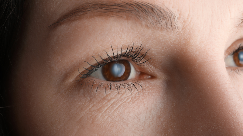 Tiểu đường có thể gây đục thủy tinh thể