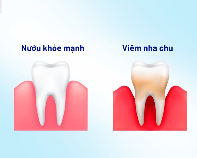 Biến chứng tiểu đường ở răng và cách phòng ngừa biến chứng tiểu đường ở răng 2