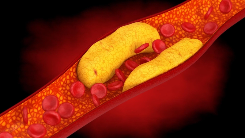 Biến chứng xơ vữa động mạch: Những nguy cơ tiềm ẩn và cách phòng ngừa hiệu quả 1