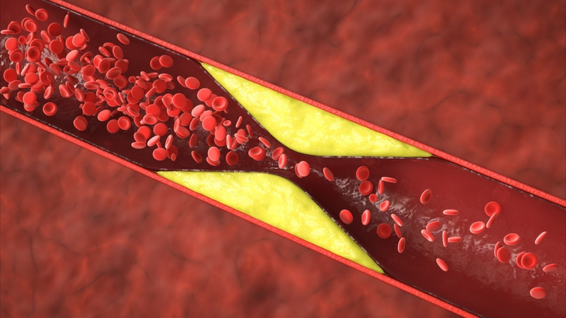 Biến chứng xơ vữa động mạch: Những nguy cơ tiềm ẩn và cách phòng ngừa hiệu quả 3