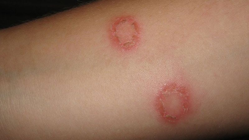 Biện pháp điều trị và chăm sóc khi hắc lào giai đoạn cuối 1