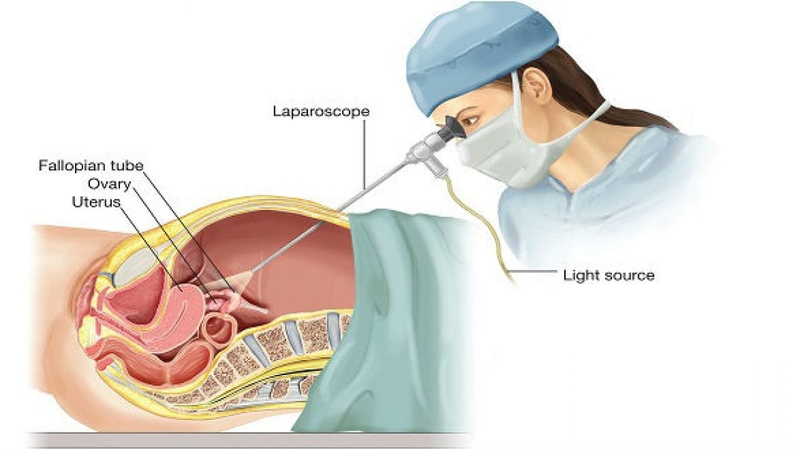 Biện pháp phẫu thuật mổ bụng giúp triệt sản