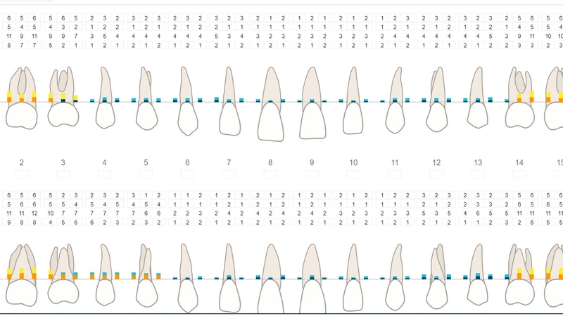 Biểu đồ nha chu là phương pháp đo khoảng cách giữa răng và mô nướu xung quanh