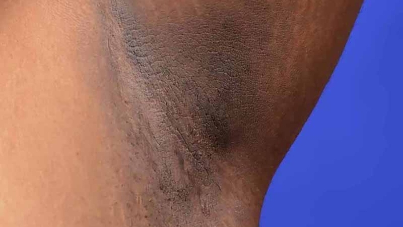 Biểu hiện của bệnh gai đen và cách điều trị 3