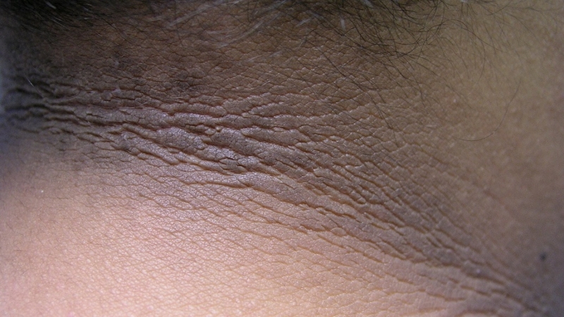 Biểu hiện của bệnh gai đen và cách điều trị 1