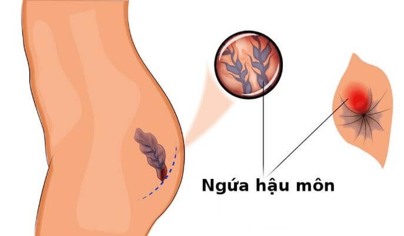 Bệnh trĩ có tự khỏi được không 1