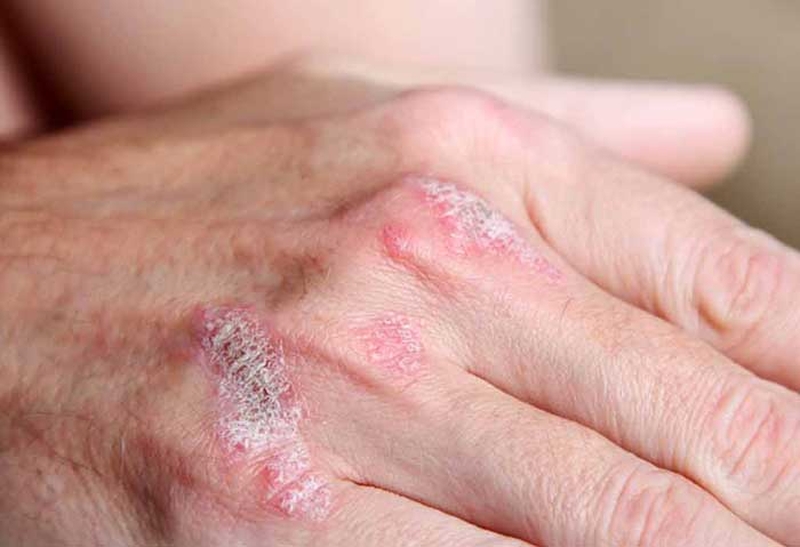 Biểu hiện của bệnh vảy nến không phải ai cũng biết