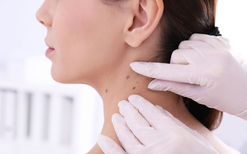 bieu-hien-cua-not-ruoi-khong-dien-hinh-nhu-the-nao 1.jpg