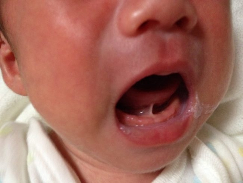 Trẻ bị dính thắng lưỡi chậm nói và những điều cần lưu ý. 2