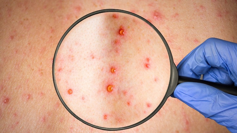 Điều cần biết về quai bị và thủy đậu, phân biệt chúng ra sao? 2