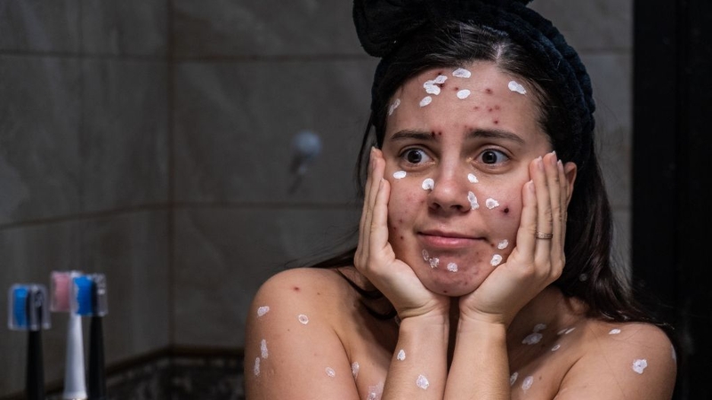 Điều cần biết về quai bị và thủy đậu, phân biệt chúng ra sao? 4