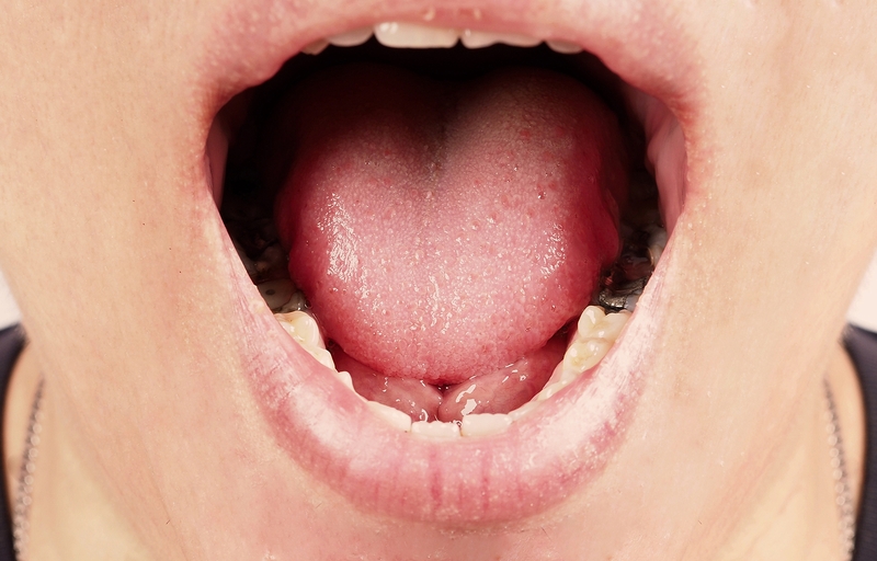 Biểu hiện răng sâu độ 4 là như thế nào? 1