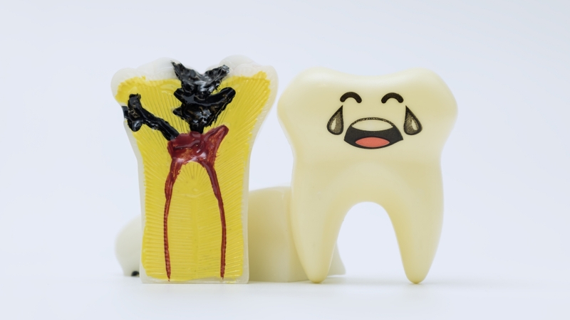Sâu răng đến tủy thường cần điều trị tủy trước khi phục hồi thân răng