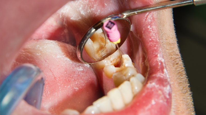 Điều trị tủy răng là phương pháp được chỉ định phổ biến nhất khi sâu răng đã gây viêm tủy không hồi phục