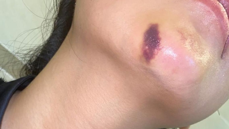 Sưng đau kéo dài hoặc khó nuốt là những dấu hiệu cần được thăm khám sớm