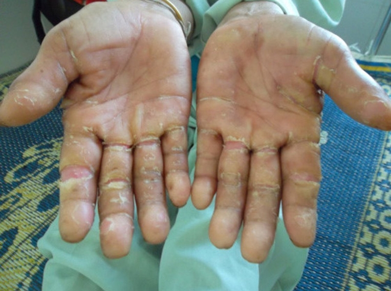 Biểu hiện và cách chữa trị bệnh dị ứng xi măng 1