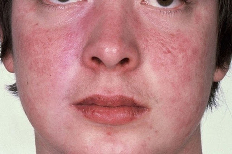 Biểu hiện và giải pháp điều trị lupus ban đỏ ở nam giới 2