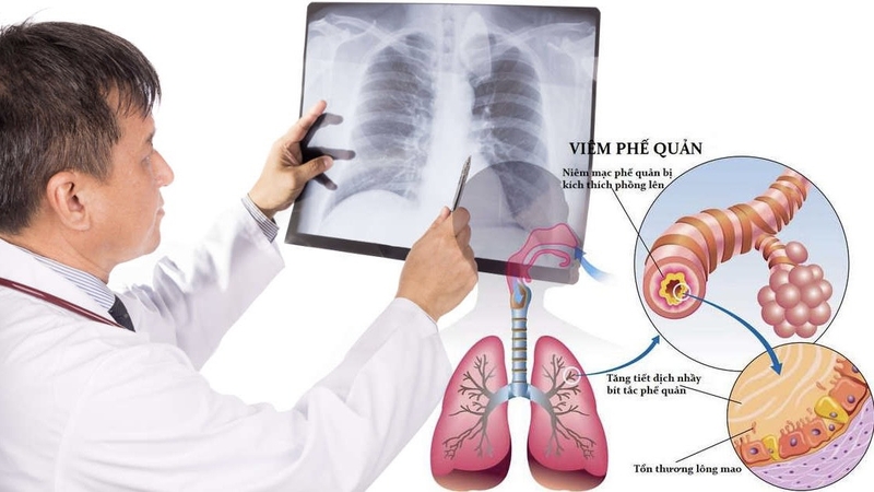 bieu-hien-viem-phe-quan-nhan-dien-som-de-dieu-tri-kip-thoi 1