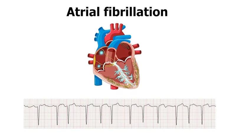 Bít tiểu nhĩ - Giải pháp ngăn ngừa đột quỵ ở bệnh nhân rung nhĩ 1