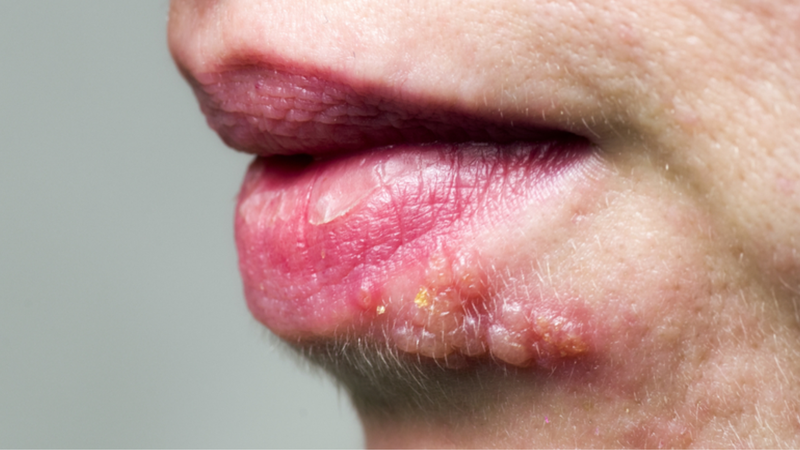 Bạn có nguy cơ bị herpes miệng khi thực hiện BJ