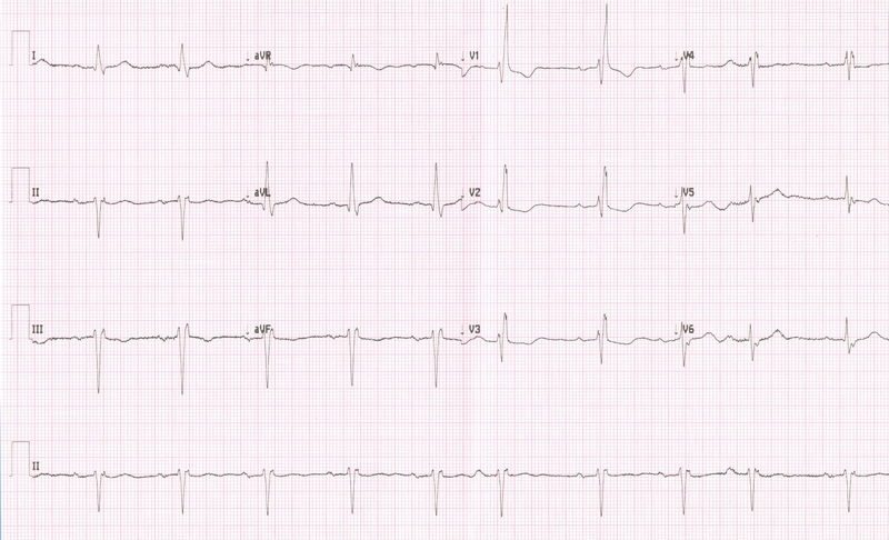 Block nhĩ thất độ 1 là gì? Có nguy hiểm không 1