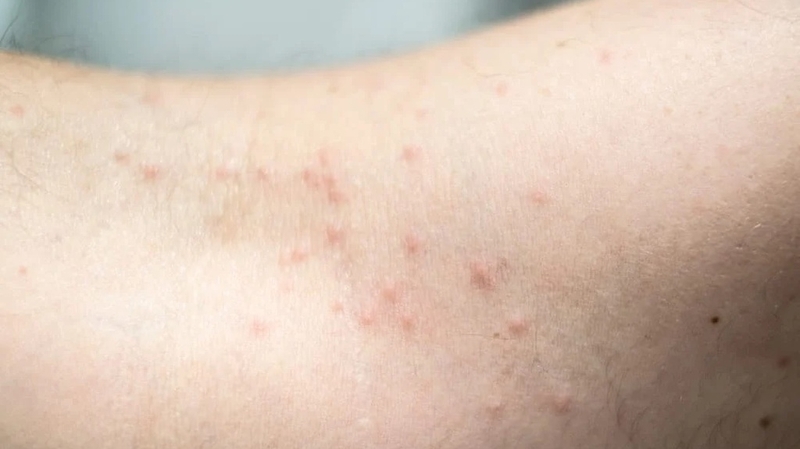 Bọ chét cắn có sao không? Nguyên nhân và cách xử lý 3