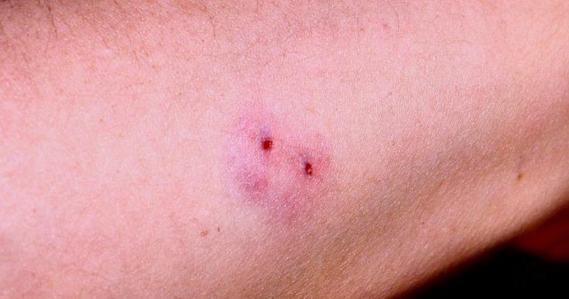 Bố mẹ nên làm gì để sơ cứu khi bé bị rắn cắn 1