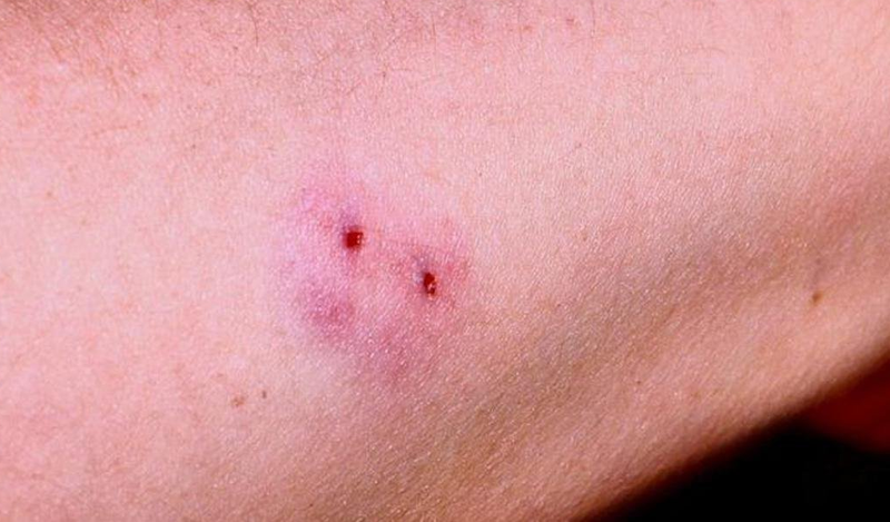 Phân biệt các cách sơ cứu ban đầu khi bị rắn cắn 3