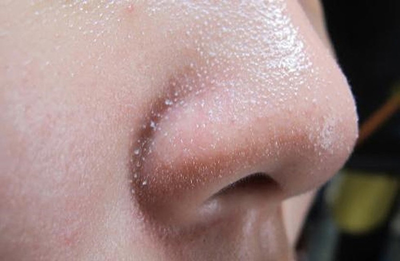 Bỏ túi ngay 04 cách trị mụn cám ở mũi cực hiệu quả 1