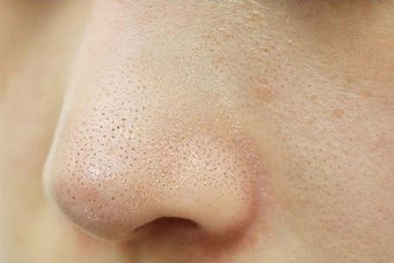 Bỏ túi ngay 04 cách trị mụn cám ở mũi cực hiệu quả 2