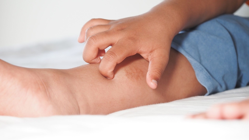 Ngứa ngáy dữ dội do sán chó là triệu chứng khiến nhiều người khó chịu