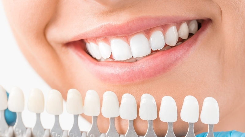 Bọc răng Composite là gì? Ưu, nhược điểm bạn nên biết 2