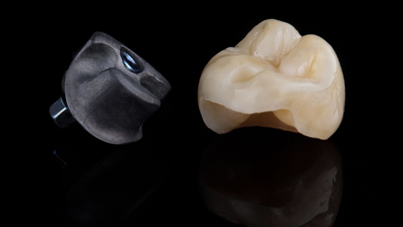 Bọc răng hàm bị sâu giá bao nhiêu? Quy trình thực hiện 4