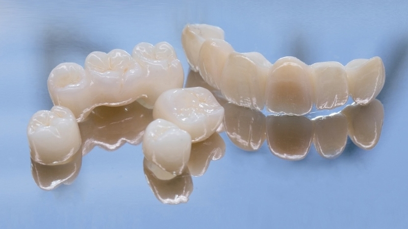 Bọc răng sứ 4 răng cửa giá bao nhiêu? Nên bọc loại nào tốt? 4