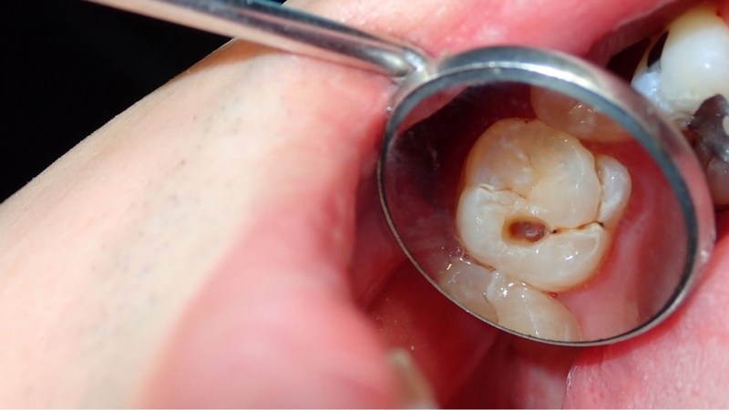 Khe hở giữa răng sứ và cùi răng là nơi dễ tích tụ vi khuẩn
