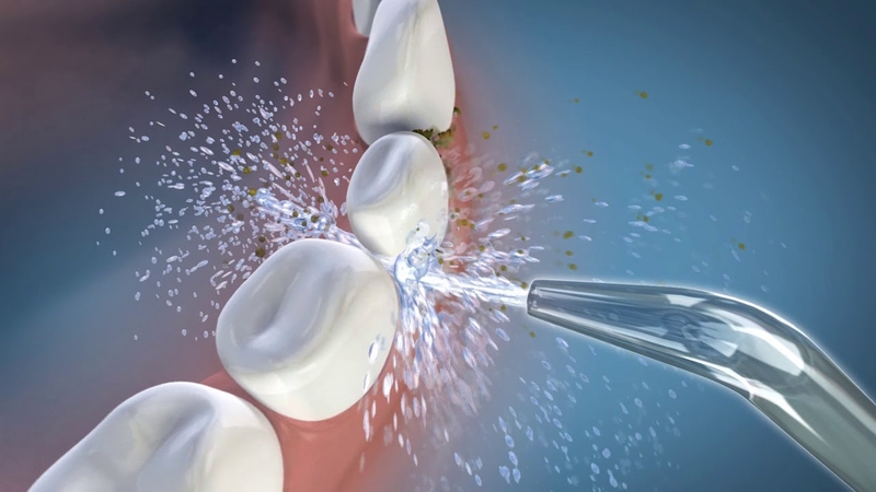 Bọc răng sứ có nên dùng tăm nước không? Vì sao? 2