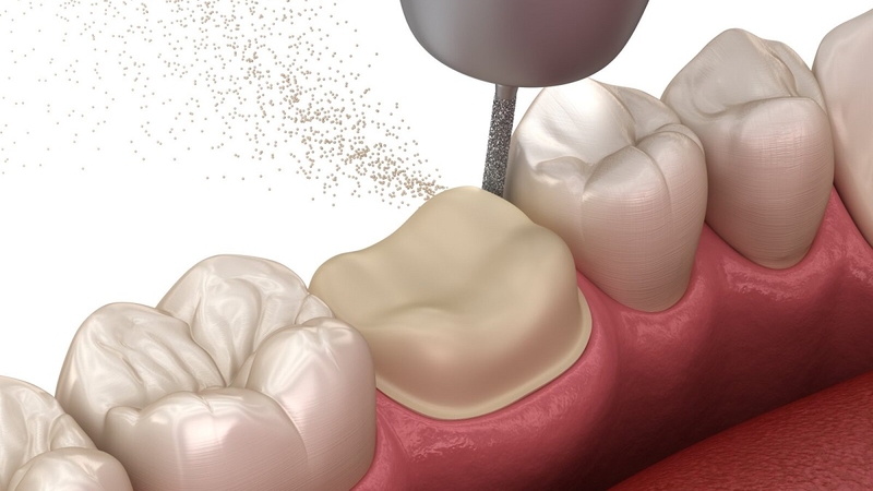 Bọc răng sứ có phải mài răng không? Quy trình mài răng bọc răng sứ chuẩn 2
