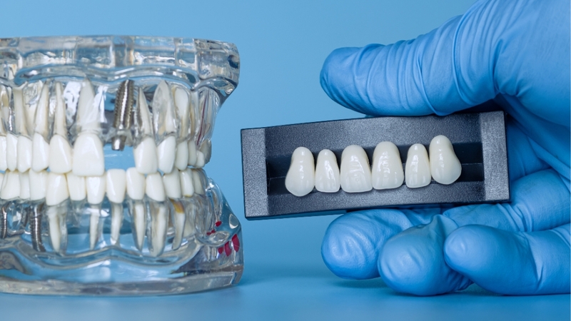 Câu trả lời cho thắc mắc bọc răng sứ giá bao nhiêu