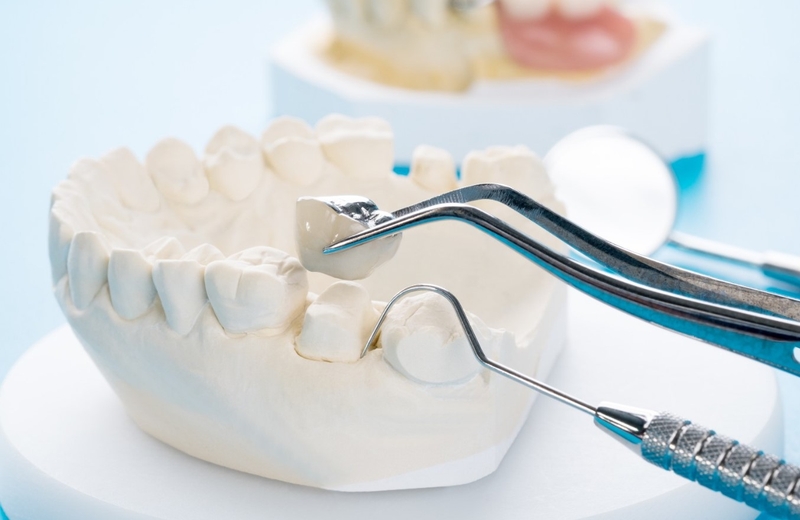 Bọc răng sứ Inox: Ưu, nhược điểm và những điều cần chú ý trước khi làm 3