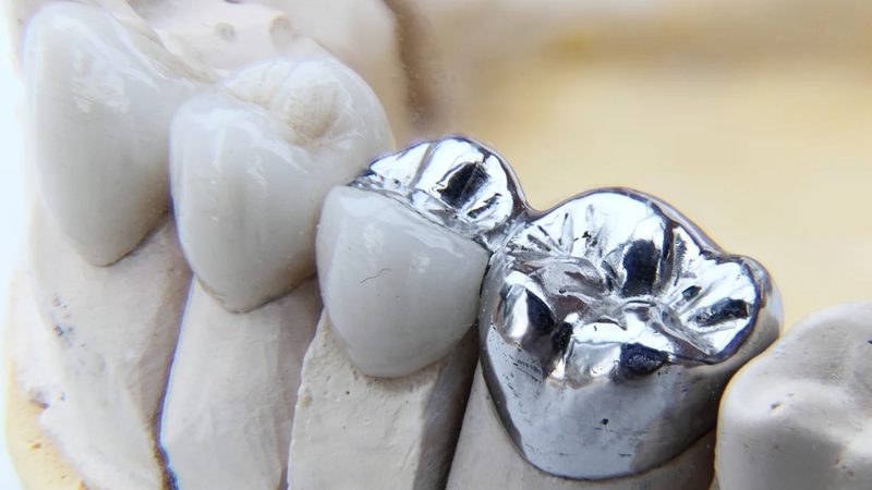 Bọc răng sứ Inox: Ưu, nhược điểm và những điều cần chú ý trước khi làm 4