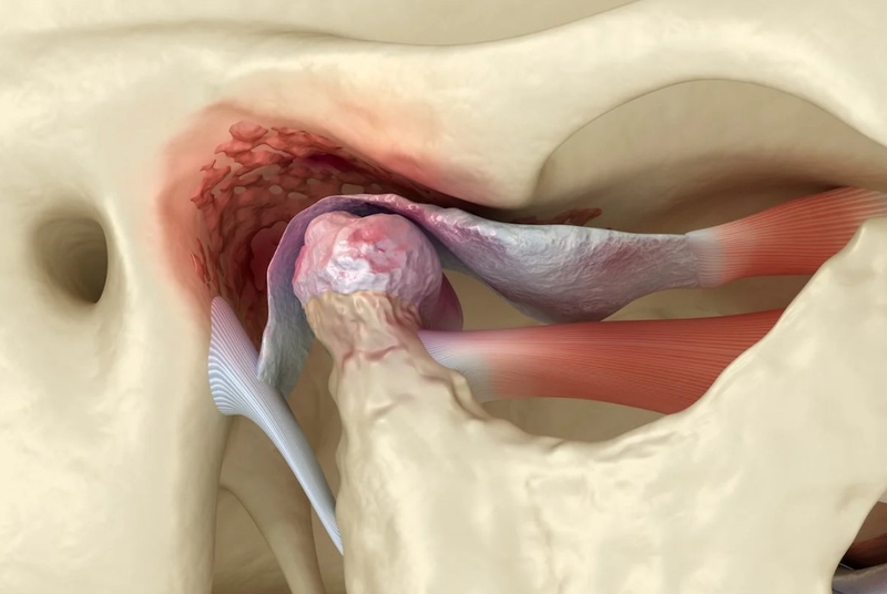 Bọc răng sứ Inox: Ưu, nhược điểm và những điều cần chú ý trước khi làm 5