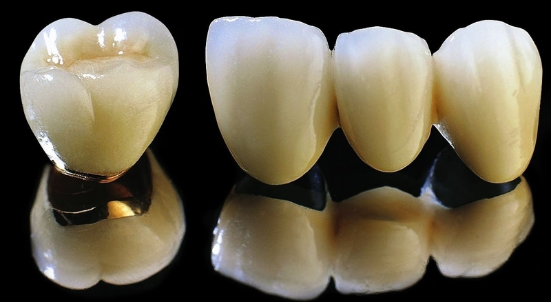 Bọc răng sứ sau khi lấy tủy có đau không? Tuổi thọ sử dụng bao nhiêu năm? 3