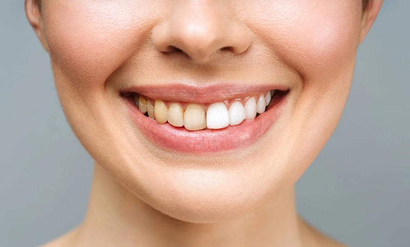Bọc răng sứ thẩm mỹ và những điều bạn cần biết 4