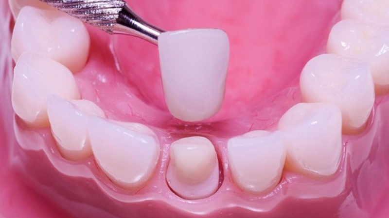 Cần phải tháo răng sứ khi cùi răng thật gặp vấn đề
