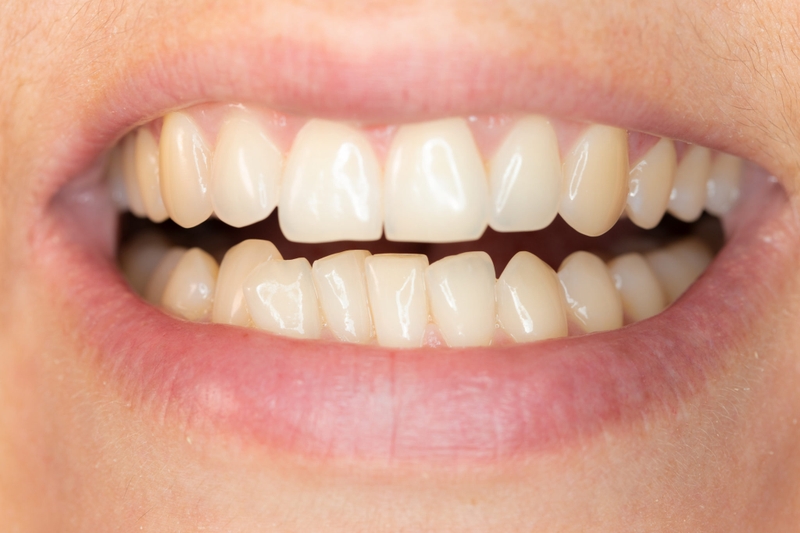Bọc sứ cho răng mọc lệch như thế nào? Chi phí ra sao? 2
